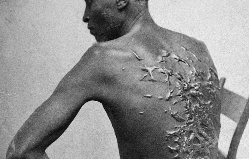 עבד שחור שגבו מצולק ממלקות, 1863   מקור: ויקיפדיה